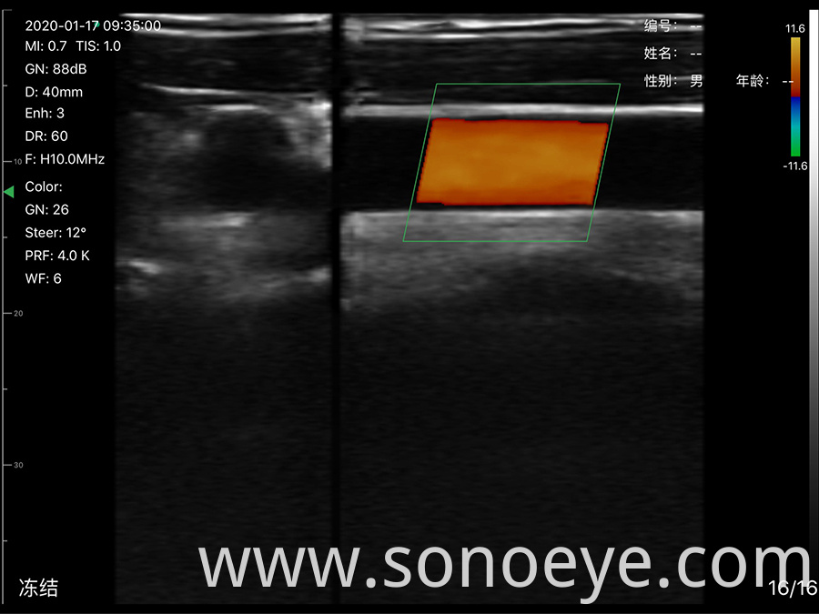 wirelss ultrasound